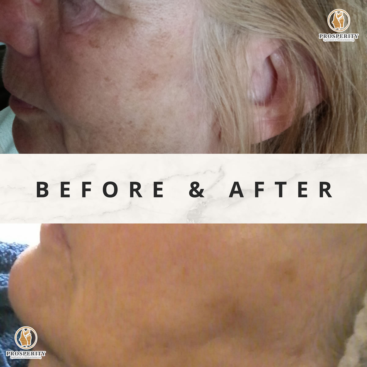 bioree-before-after_